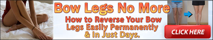 Bow legs no more